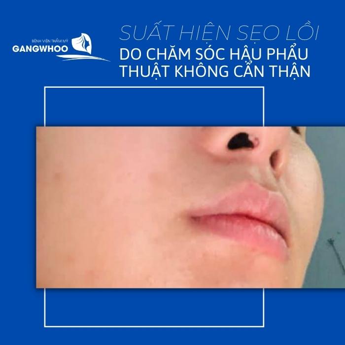 Mũi bị sẹo lồi nếu không kĩ lưỡng trong quá trình chăm sóc