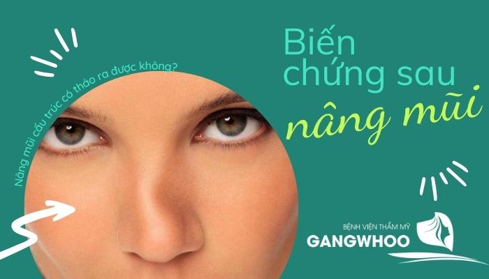 Nghi vấn nâng mũi cấu trúc có tháo ra được không?