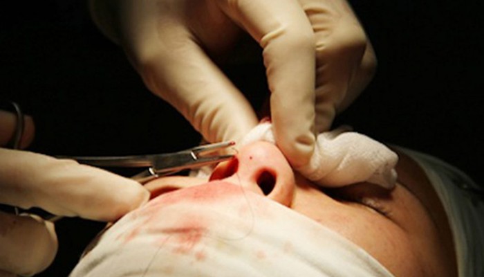 Kỹ thuật tay nghề nâng mũi của bác sĩ kém khiến mũi bị cứng sau nâng