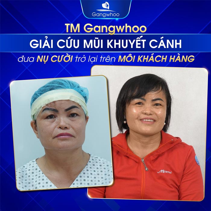 Hình ảnh khách hàng trước và sau khi nâng mũi tại bệnh viện thẩm mỹ Gangwhoo