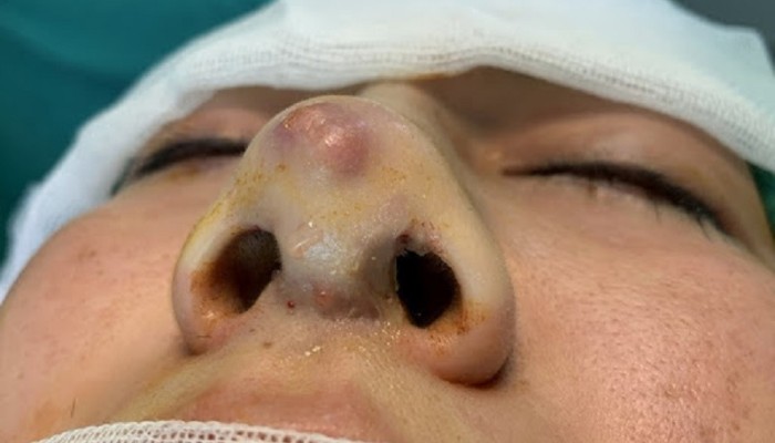 Hiện tượng ứ dịch sau nâng mũi