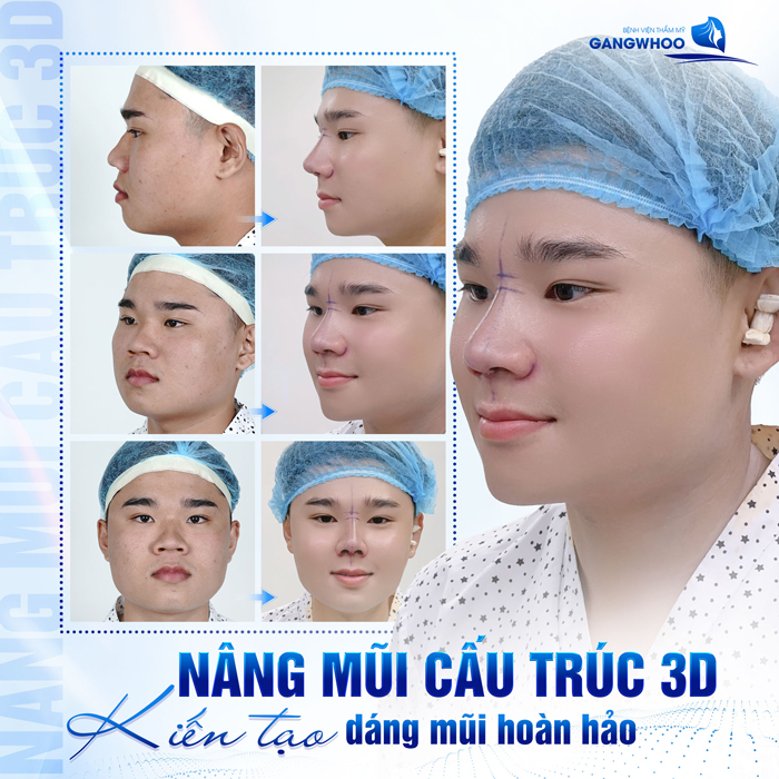 Đẹp Như Gái Hàn Nếu Biết Đến 3 Nơi Nâng Mũi Ở Phú Thọ Sau