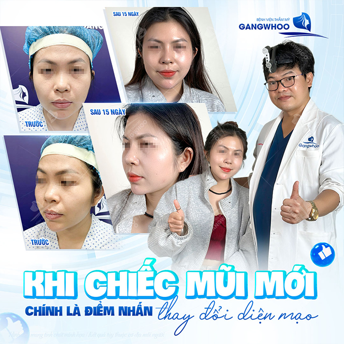 Nâng mũi high line giá bao nhiêu? Cập nhật chi phí mới nhất