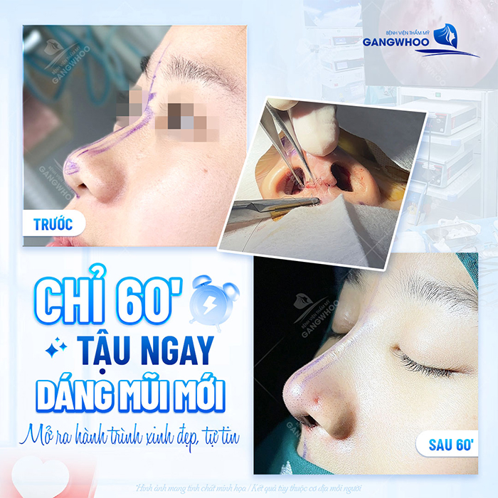 Nâng mũi high line giá bao nhiêu? Cập nhật chi phí mới nhất