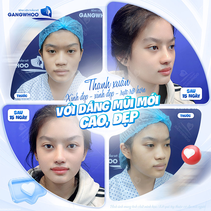 Nâng mũi high line giá bao nhiêu? Cập nhật chi phí mới nhất