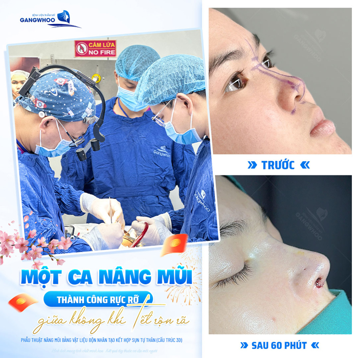 Tìm hiểu về nâng mũi S Line bọc sụn prosil