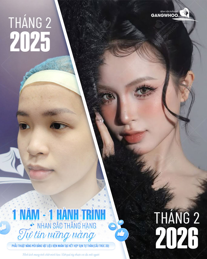 Tìm hiểu về nâng mũi S Line bọc sụn prosil