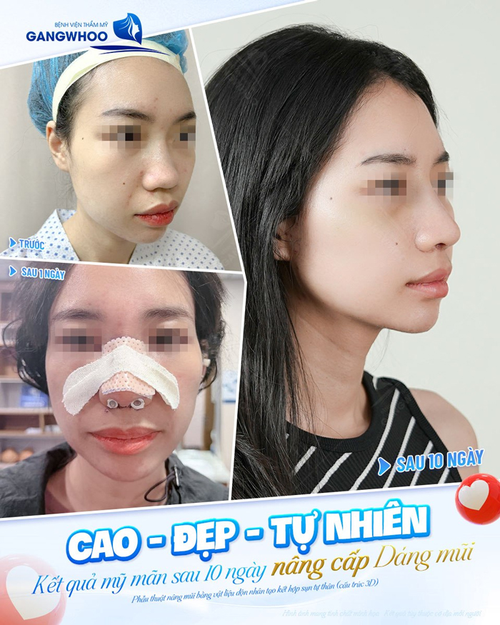 Tìm hiểu về nâng mũi S Line bọc sụn prosil