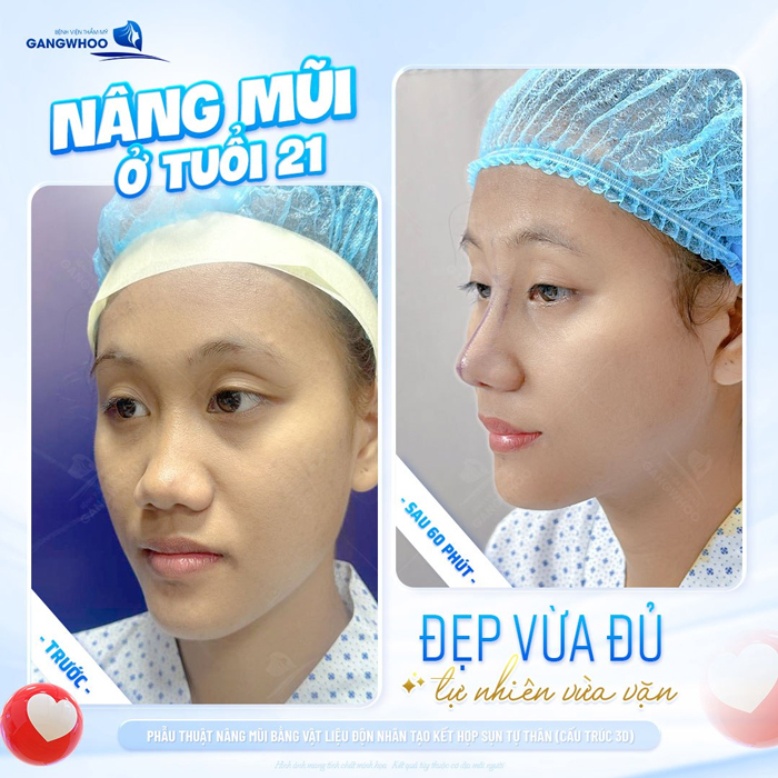 Tìm hiểu về nâng mũi S Line bọc sụn prosil