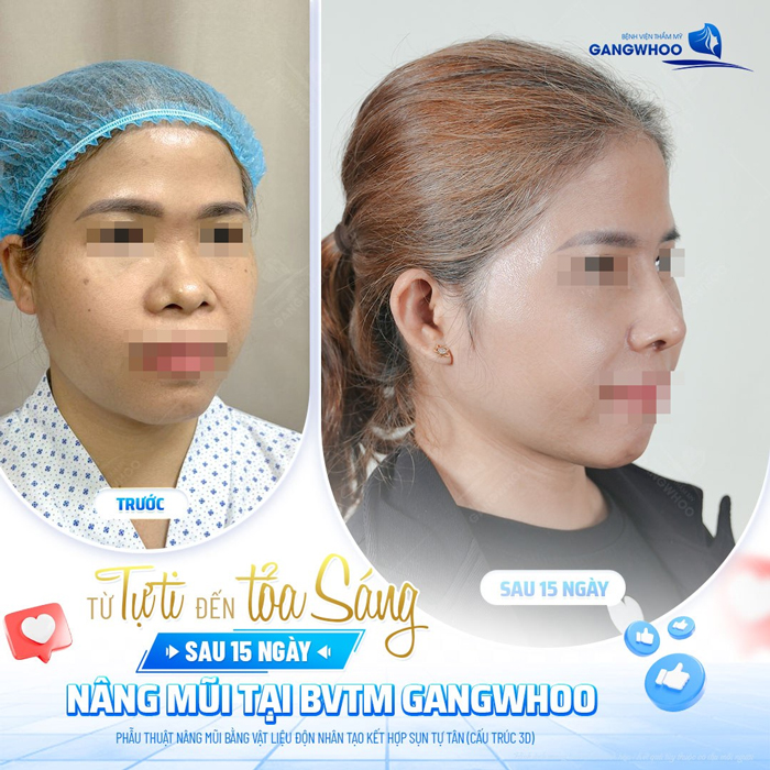 Tìm hiểu về nâng mũi S Line bọc sụn prosil