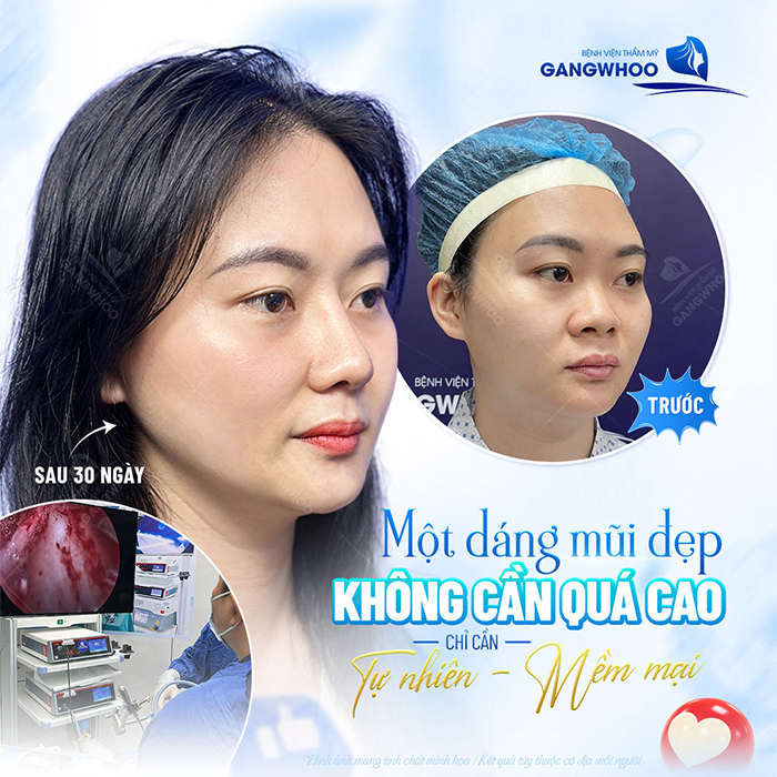 Nâng mũi sụn nhân tạo: Ưu điểm, quy trình thực hiện và chi phí