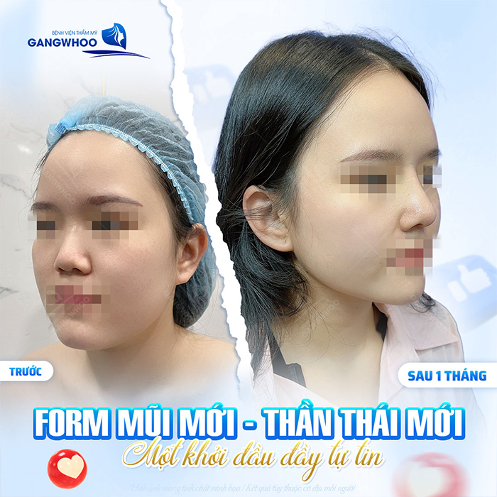 Nâng mũi sụn nhân tạo: Ưu điểm, quy trình thực hiện và chi phí