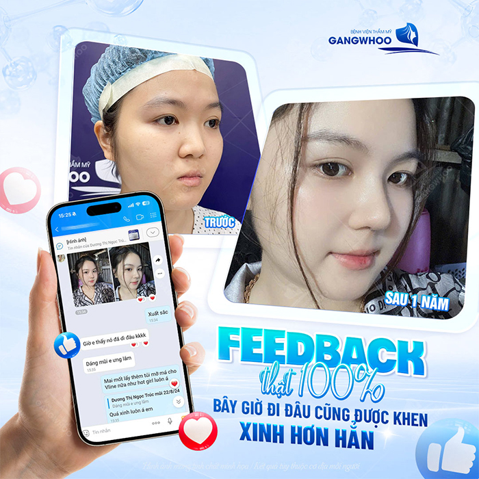 Nâng mũi sụn nhân tạo: Ưu điểm, quy trình thực hiện và chi phí