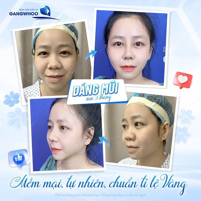 Nâng mũi sụn nhân tạo: Ưu điểm, quy trình thực hiện và chi phí