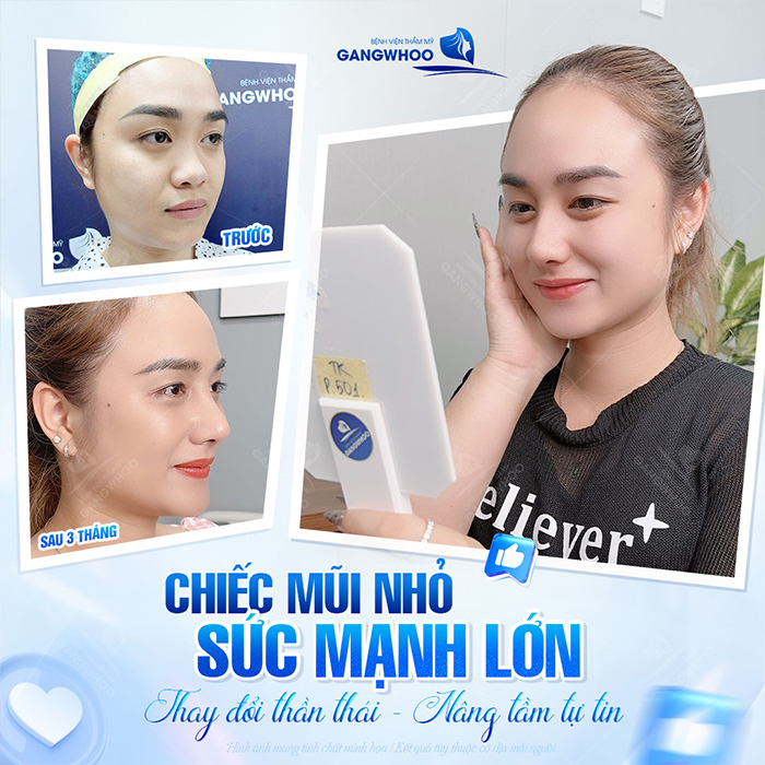 Nâng mũi sụn nhân tạo: Ưu điểm, quy trình thực hiện và chi phí