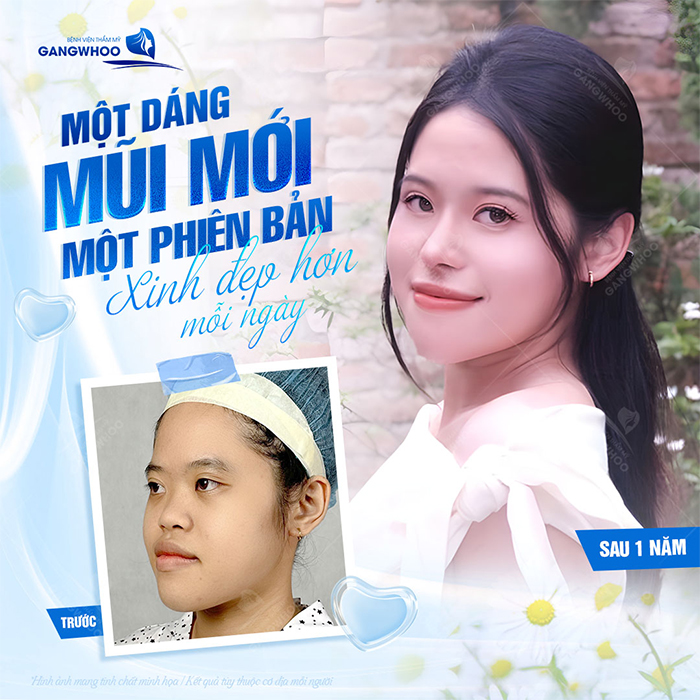 Nâng mũi sụn nhân tạo: Ưu điểm, quy trình thực hiện và chi phí