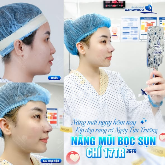 Dáng mũi thay đổi từng ngày trong thời gian lành sau nâng sụn tai