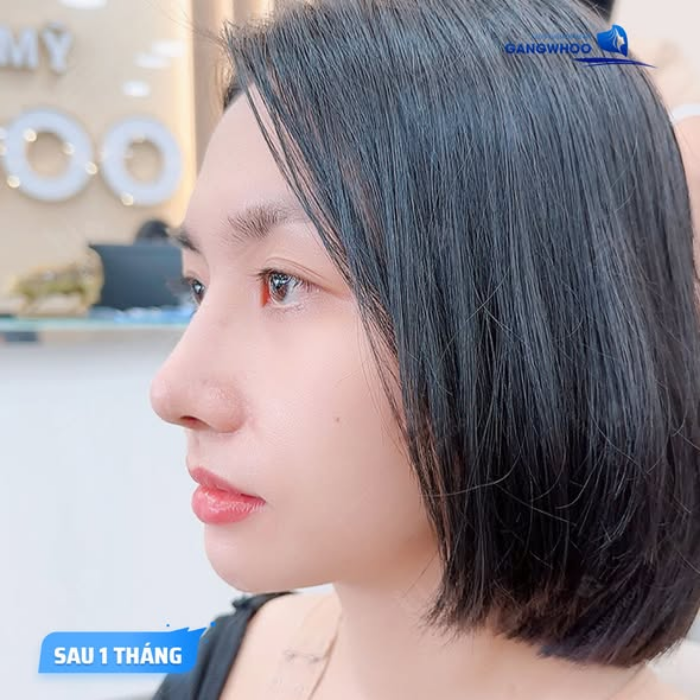 Kết quả sau khi mũi đã qua giai đoạn lành thương tiêu chuẩn