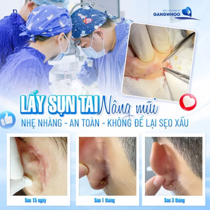 Công nghệ nâng mũi sử dụng sụn tai tự thân cho độ tương thích cao