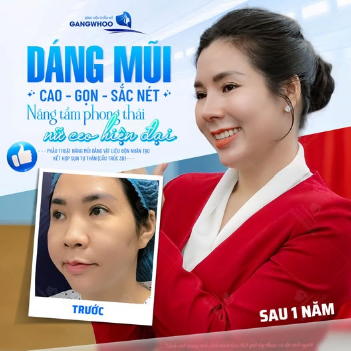 Dáng mũi sau nâng sụn tai duy trì form tự nhiên theo thời gian