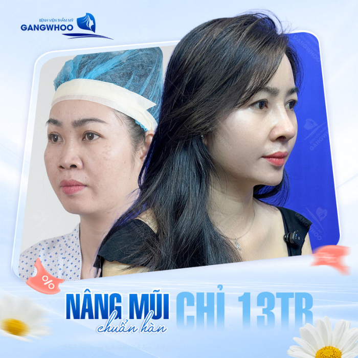 Quá trình hồi phục của mũi sau nâng sụn tai – form dáng rõ ràng