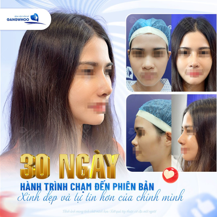 Hành trình thay đổi bản thân sau khi nâng mũi cấu trúc 3D