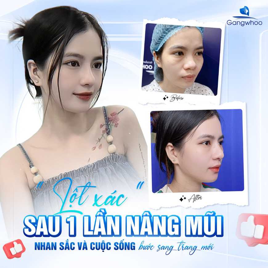 Kết quả nâng mũi đẹp tự nhiên – dáng mũi hài hòa với gương mặt