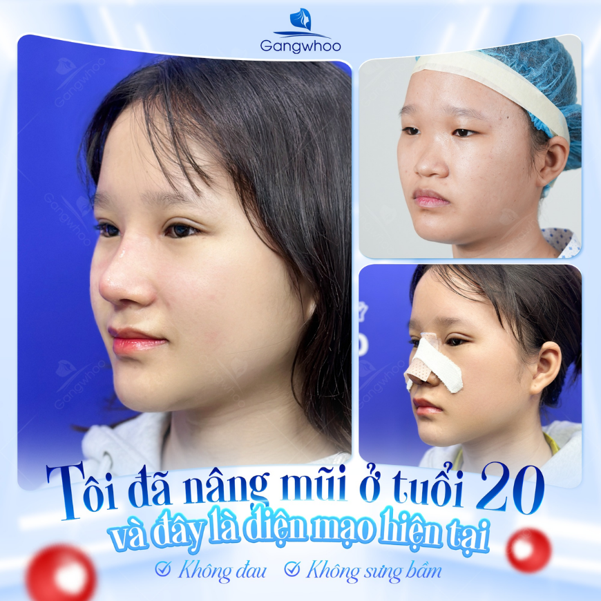 Hình ảnh khách hàng sau nâng mũi đẹp tự nhiên – dáng mũi thanh thoát