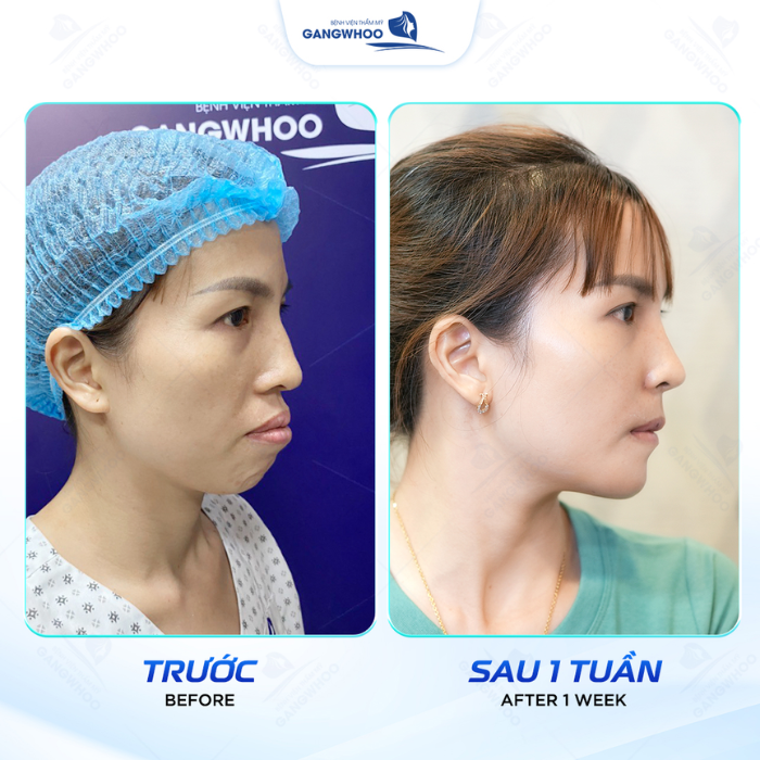 Hình ảnh khách hàng sau nâng mũi S-Line sụn sườn