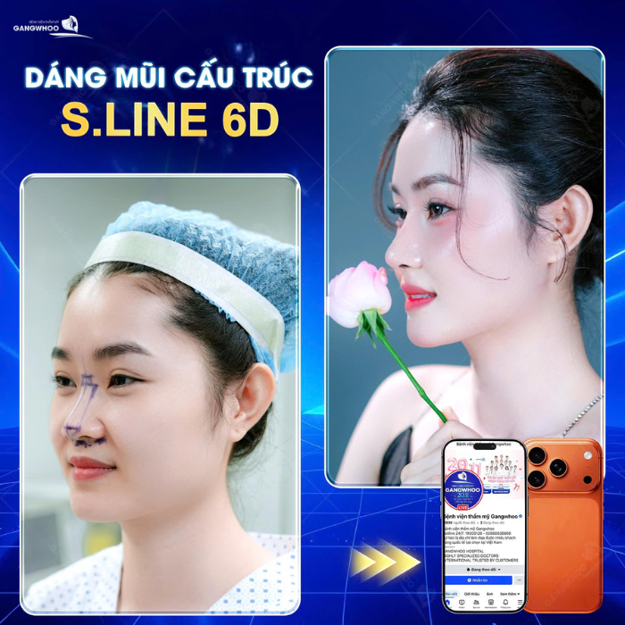 Form mũi S-Line sau nâng sụn sườn – đường cong hài hòa