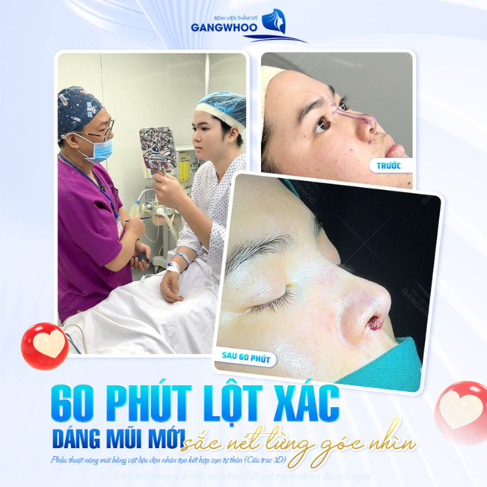 Kết quả nâng mũi cho đường nét thanh thoát, do bác sĩ chuyên môn cao thực hiện