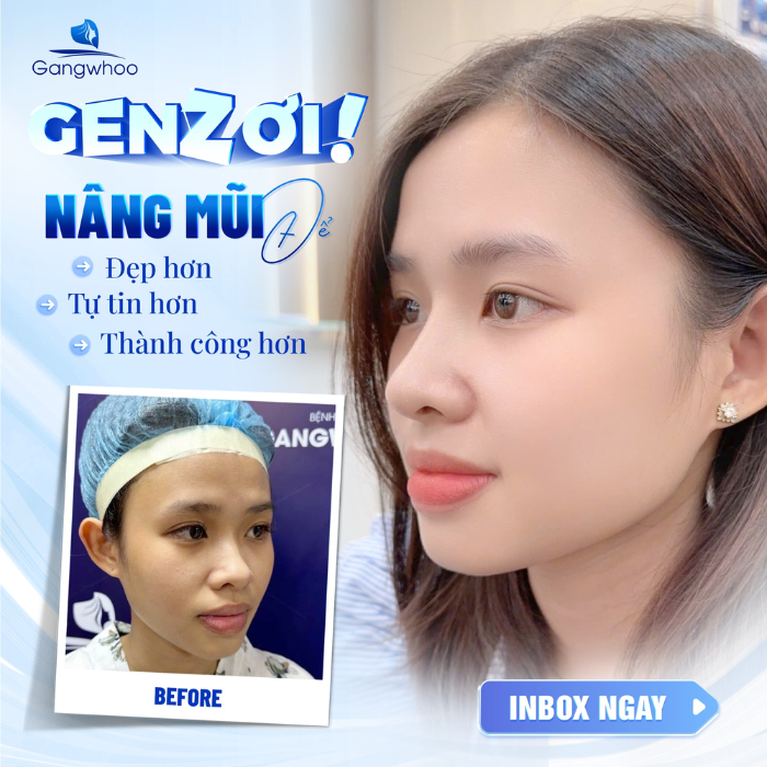 Tự tin hơn nhờ nâng mũi tự thân tại Bệnh viện thẩm mỹ Gangwhoo