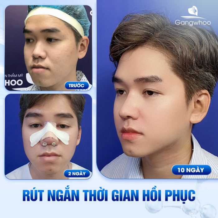Phẩu thuật nâng mũi tự thân