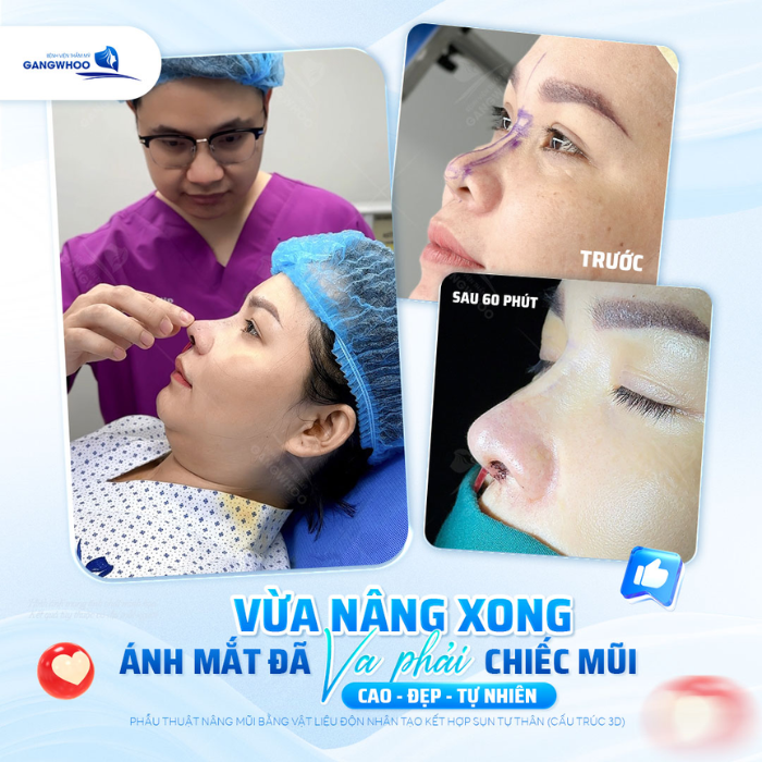Kết quả sau 60 phút phẩu thuật nâng mũi tự thân