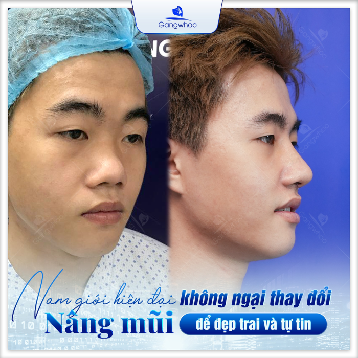 Nam giới hiên đại không ngại nâng mũi để đẹp trai và tự tin