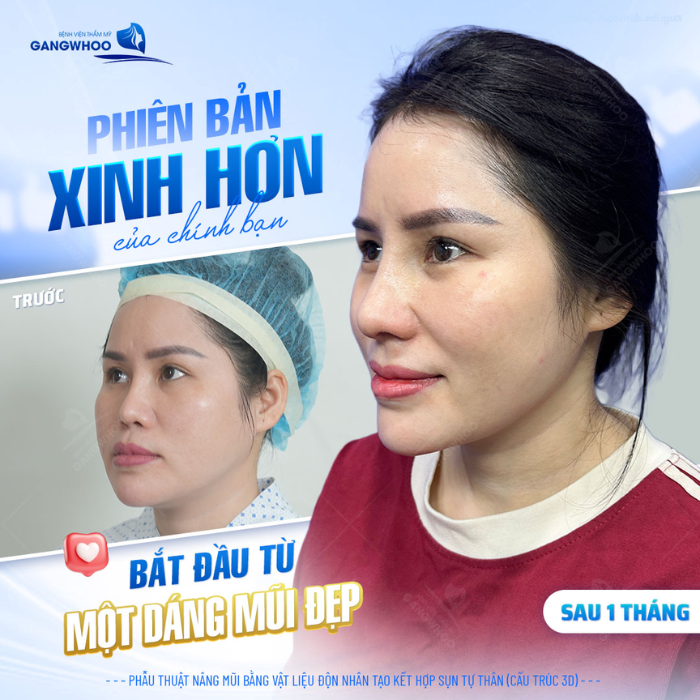 Trở thành phiên bản mới sau khi nâng mũi cấu trúc 3D