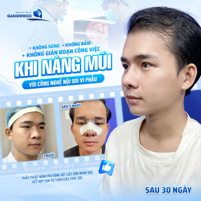 Sự thay đổi ngoạn mục sau khi nâng mũi cấu trúc 3D