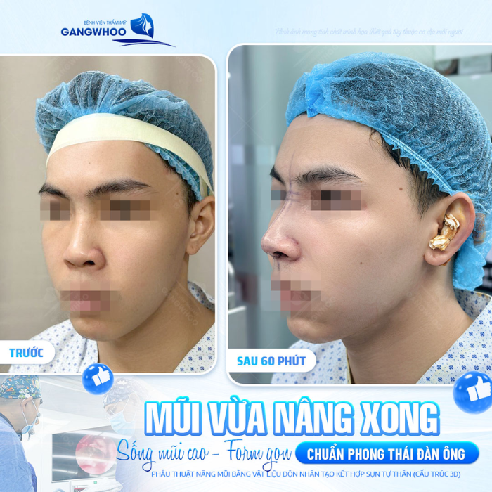 Hình ảnh trước và sau khi nâng mũi cấu trúc 3D của khách hàng