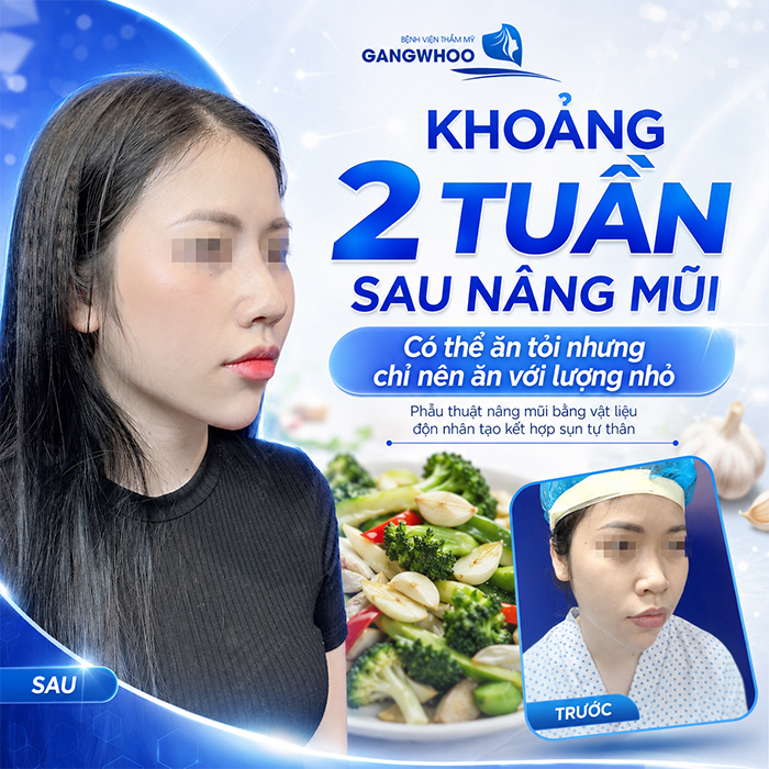 Nâng Mũi Ăn Tỏi Được Không? Bác Sĩ Giải Đáp Từ Góc Nhìn Y Khoa