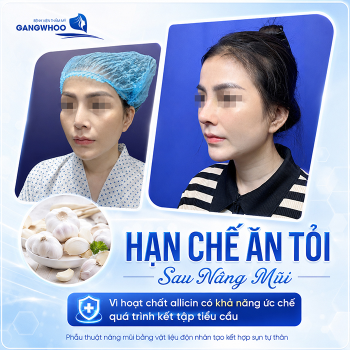 Nâng Mũi Ăn Tỏi Được Không? Bác Sĩ Giải Đáp Từ Góc Nhìn Y Khoa
