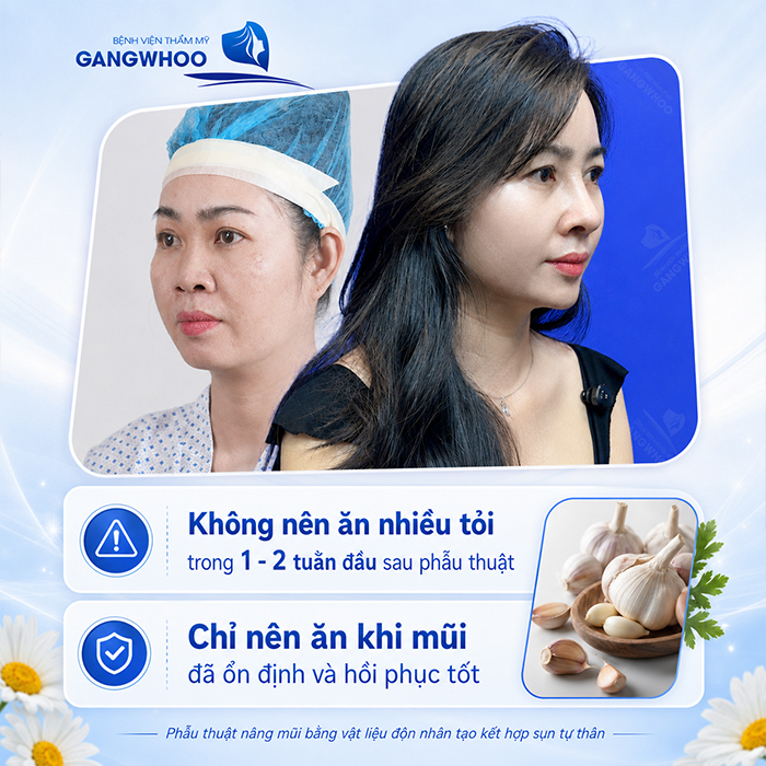 Nâng Mũi Ăn Tỏi Được Không? Bác Sĩ Giải Đáp Từ Góc Nhìn Y Khoa