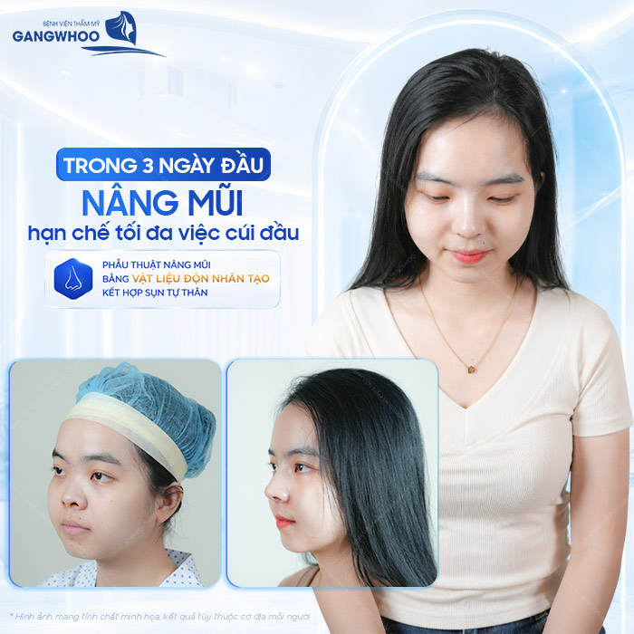 Nâng Mũi Bao Lâu Được Cúi Đầu? Cúi Đầu Sớm Có Nguy Hiểm Không?
