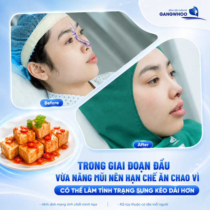 Nâng Mũi Ăn Chao Được Không? Bao Lâu Có Thể Ăn Lại?