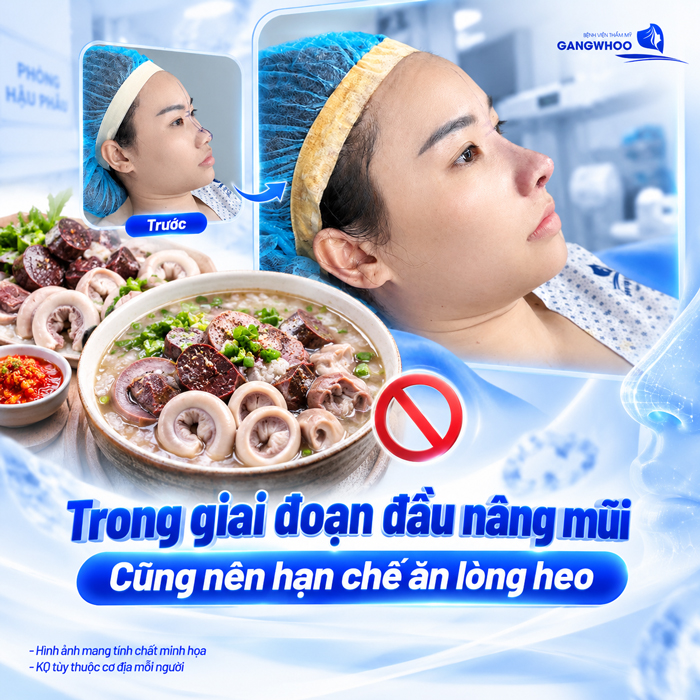 Nâng Mũi Ăn Lòng Heo Được Không? Bác Sĩ Giải Đáp Chi Tiết