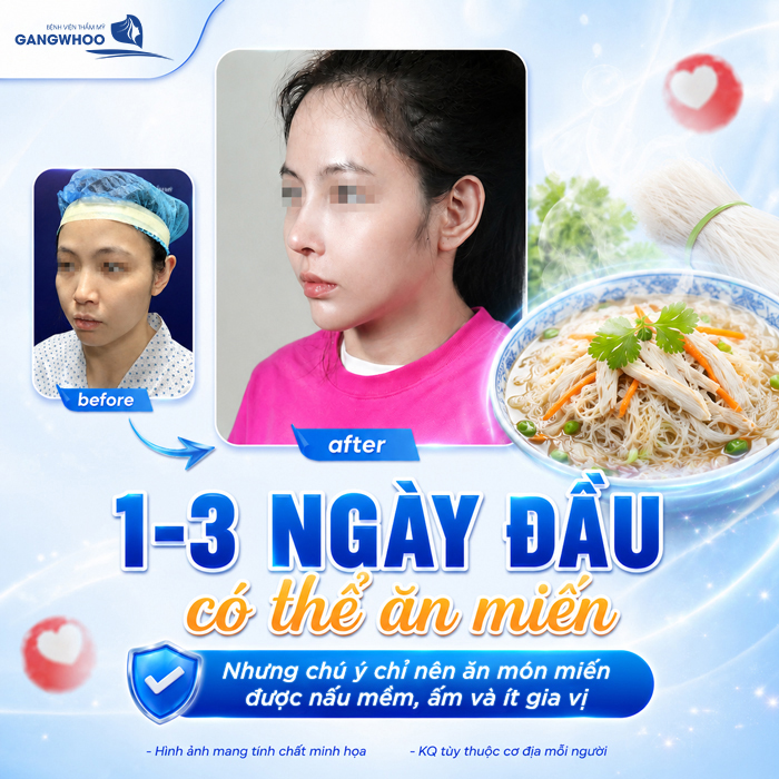Nâng Mũi Ăn Miến Được Không? Bao Lâu Thì Ăn Được?