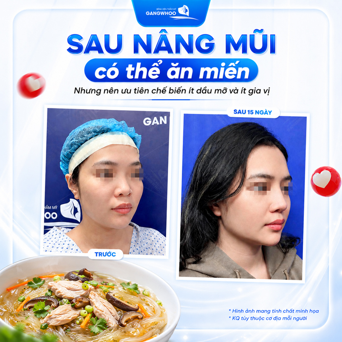 Nâng Mũi Ăn Miến Được Không? Bao Lâu Thì Ăn Được?