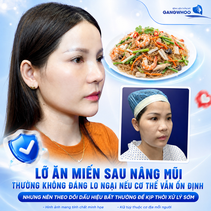 Nâng Mũi Ăn Miến Được Không? Bao Lâu Thì Ăn Được?