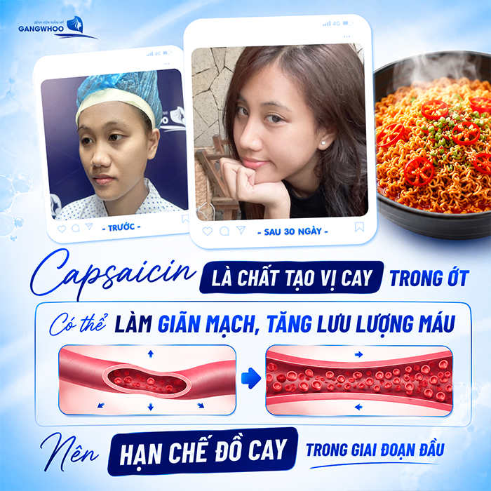 Nâng Mũi Bao Lâu Được Ăn Mì Cay? Bác Sĩ Giải Đáp Chi Tiết Từ Góc Độ Chuyên Môn