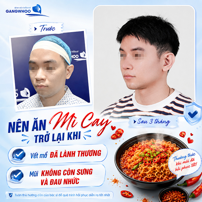 Nâng Mũi Bao Lâu Được Ăn Mì Cay? Bác Sĩ Giải Đáp Chi Tiết Từ Góc Độ Chuyên Môn