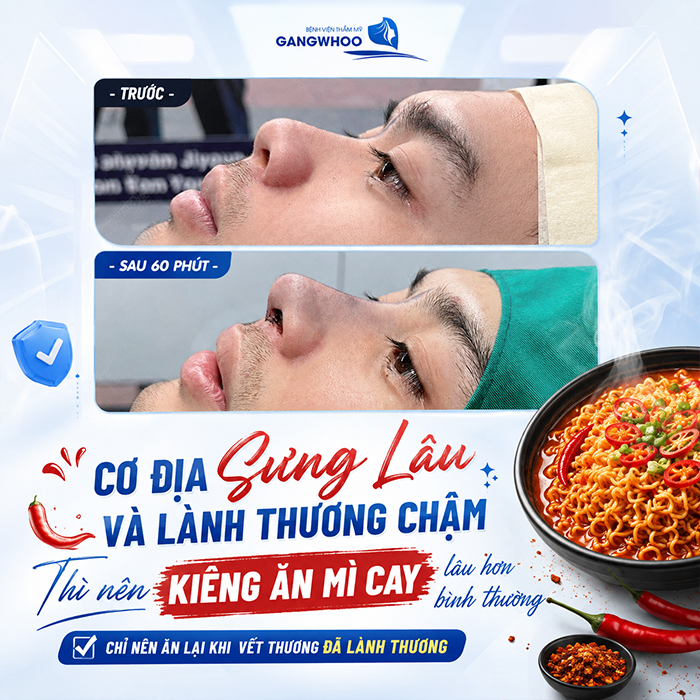 Nâng Mũi Bao Lâu Được Ăn Mì Cay? Bác Sĩ Giải Đáp Chi Tiết Từ Góc Độ Chuyên Môn